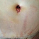 Close up of navel and incision, PO day 9. The circular mark above naval is from the pain pump.