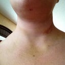 Tiny mark from chin lipo. Bruising around neck, moving down and mostly faded except my "strangulation" bruise on the left side