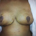 16 days post op