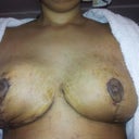 16 days post op