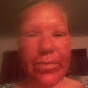 18 hours post fraxel....less oozing...swelling is starting
