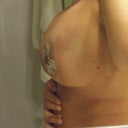 Side view 7 day post-op.