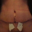 one week po - parts of my belly still seem super hard or really puffy; I'm feeling discouraged and definitely looking forward to getting rid of the drains!