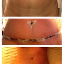 Top picture is before the other two are after tummy tuck