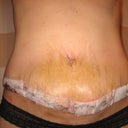Hematoma!  The discolored part is pretty distended too.