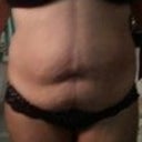 3 days pre op