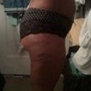10 days post op