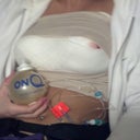 Day 1 post op with pain pump