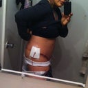 1st day post op