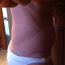 This is a side view at 9 weeks.  As you can see I'm still very thick and swollen. YUCK! My before pic looks better. :(
