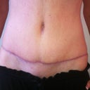 16 weeks PO, BB looks deep here. Never noticed it before just looking into the mirror. Took this after swimming so I think scar is pinker than normal due to blood flow. Might have center of scar revised at a later date. Compare freckles/mole on this pic with the yellow bra pic.