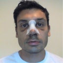 3 days post-op, yikes