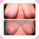 Before and After (9 weeks PO)