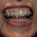 17 months into treatment