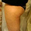 Almost two weeks later, bruises have been completely gone for 4-5 days.  The front of my legs were not touched since I can easily diet that little bit of fat layer away. My butt is trying to decide where to crease :)