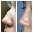 profile before and after... hump still there