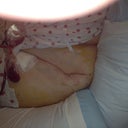 3 hours post op, sitting in hospital bed.