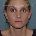 Rhinoplasty - Revision