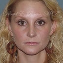 Rhinoplasty - Revision