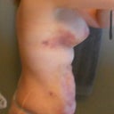 Day 1 post op.. I'll wait until the swelling goes down and the bruising improves before posting any other pictures.