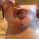 LEFT ONE AND THE SCAR IS FLATTING AND THE NIPPLE AREA STILL HAS A LOT OF SCABS AND GLUE