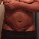 Day 8 no freakin change or hope here. Most ladies are great and going out and doing things. My body is not allowing that. I can't stand straight for a Long period