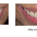 After picture is one year after my last tray. I still have to wear retainers which I do every night.