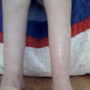 AFTER SURGERY