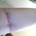 AFTER SURGERY-BACK OF KNEE