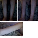 BEFORE IMPLANTS SURGERY