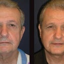 Male Necklift