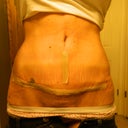 Day 24 PO with my silicone scar strips on