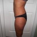 6 weeks after surgery