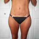 6 weeks after surgery.lol..maybe i need to get my thighs done after looking at this pic the look huge..I am a size 6 and I am happy with the results.Just have to work on my stretch marks and thighs..lol