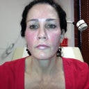 Immediately post treatment.
