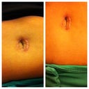 Belly button - almost 8 weeks PO