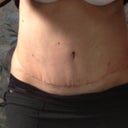 Front view 2 1/2 weeks PO.  Lost about 10 pounds from original picture.. Not feeling as hungry as stomach feels tight.. And trying to good:) drinking lots of water..