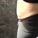 Side view 2 1/2 weeks PO