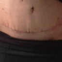 Close up of scar. Doctor says the tugs are because I'm swollen will go down once swelling gone..