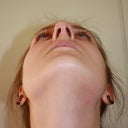 nostril underside pre-op