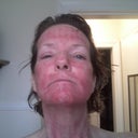 four days post-procedure