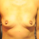 before :( Too embarrased to post before, but now I can since I have new ones. lol