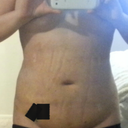 5 days Post op