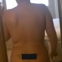 5 days post op, bra roll is being smart lipoed on the 2nd
