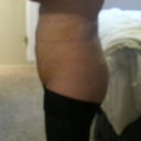 5 days post op