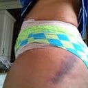 My right side bruising from lipo