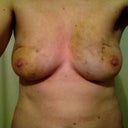 Day 8 , still lots of bruising, but not painful at all