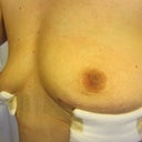 1 day post op