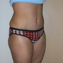Post Op 4 Weeks
