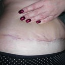 Day 40 - 5 and half wks - pulling my skin up so you can see the cut better